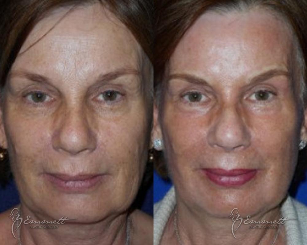 J-Plasma: Patient 8 - Before and After  