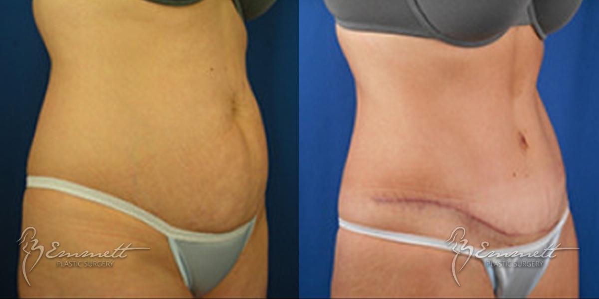 Tummy Tuck: Patient 3 - Before and After  