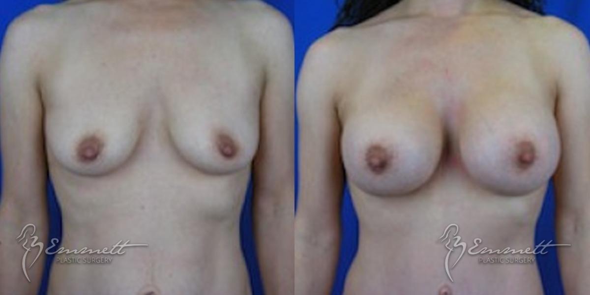 Breast Augmentation: Patient 3 - Before and After  