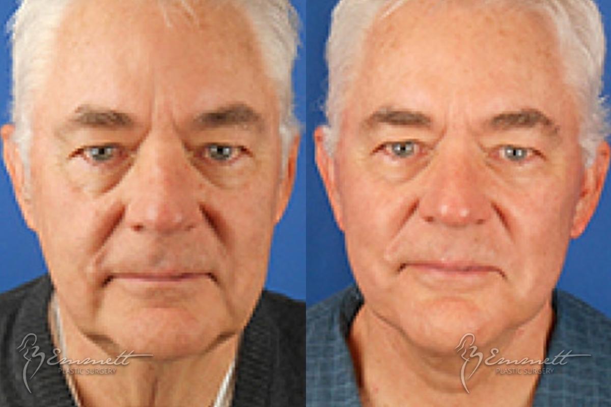 Facelift & Neck Lift: Patient 2 - Before and After  