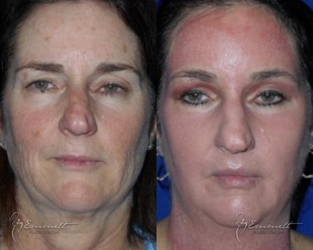 J-Plasma: Patient 7 - Before and After  