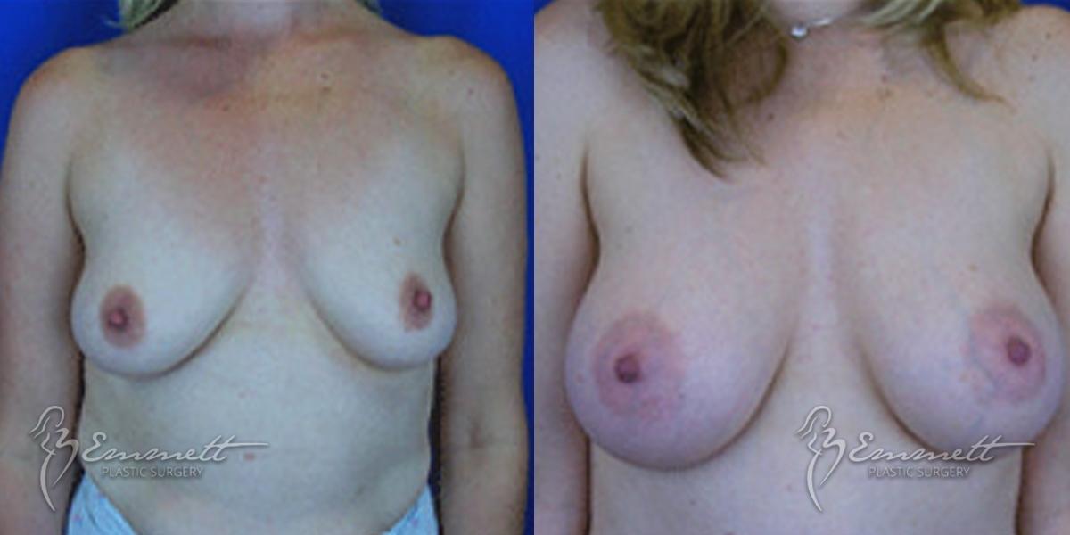 Breast Augmentation: Patient 5 - Before and After  