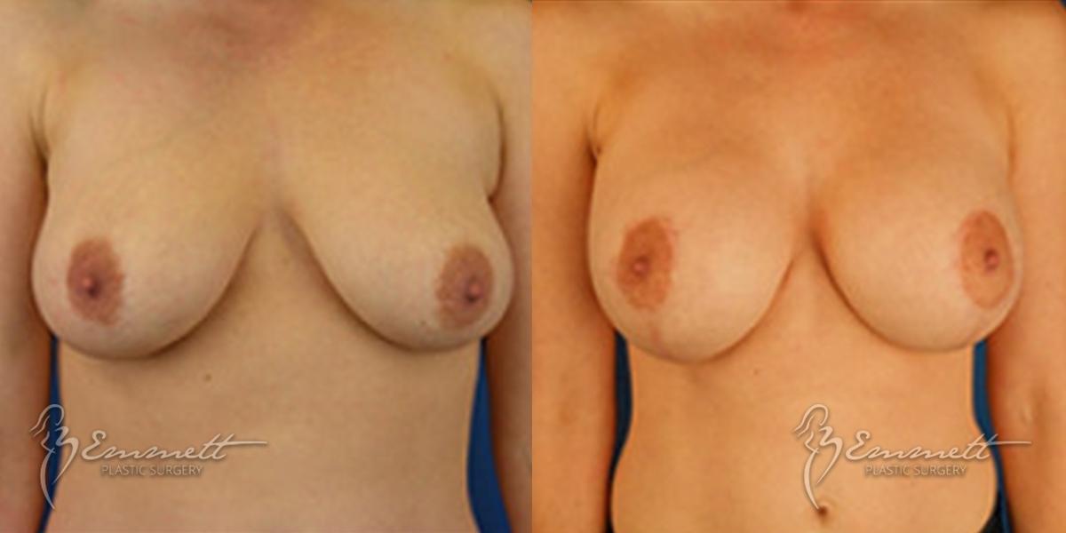 Breast Lift: Patient 2 - Before and After  