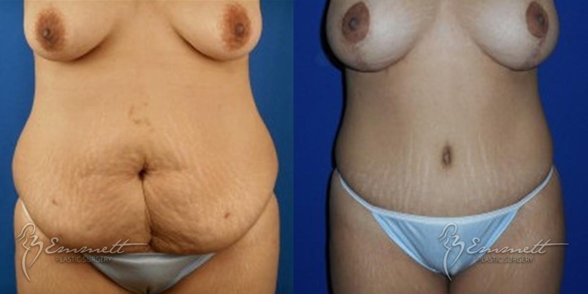 Tummy Tuck: Patient 4 - Before and After  