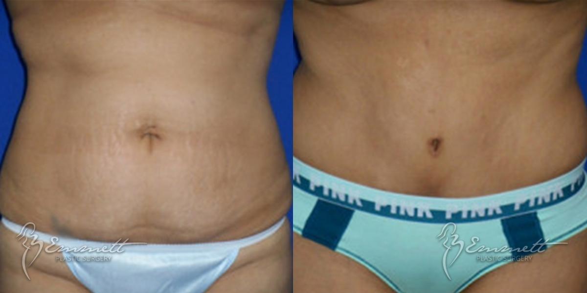 Tummy Tuck: Patient 7 - Before and After  