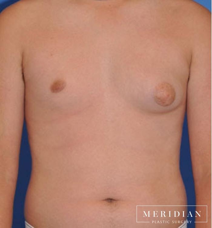 Gynecomastia: Patient 8 - After  