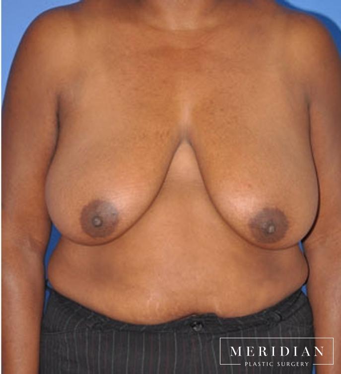 Breast Reduction: Patient 7 - After  