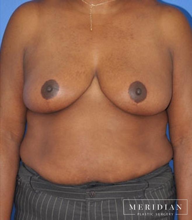 Breast Reduction: Patient 7 - After  