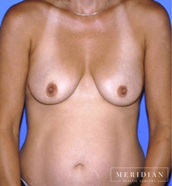 Breast Lift: Patient 4 - After  