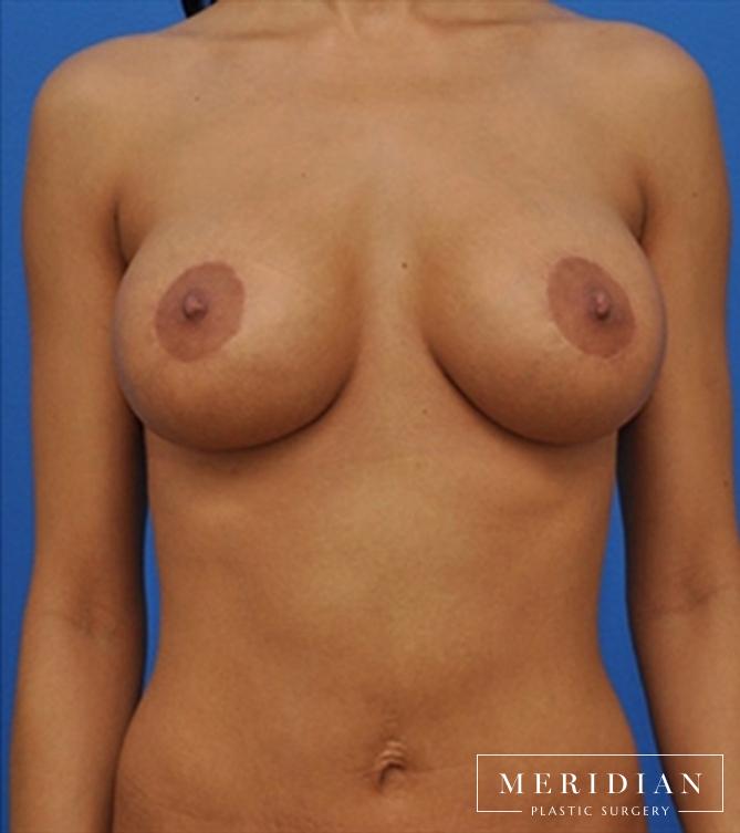 Breast Lift: Patient 1 - After  