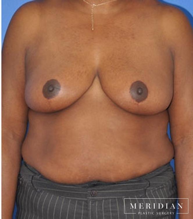 Breast Lift: Patient 3 - After  