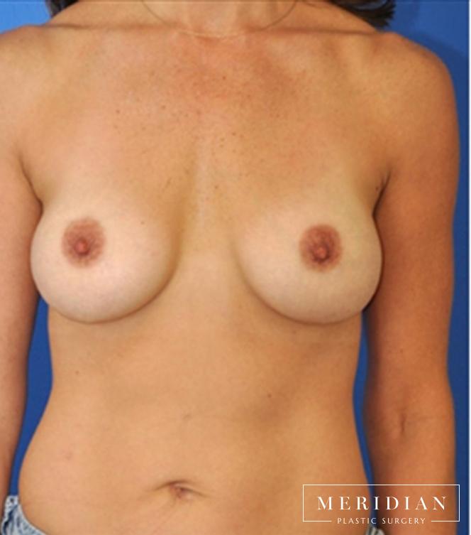 Breast Revision: Patient 8 - After  