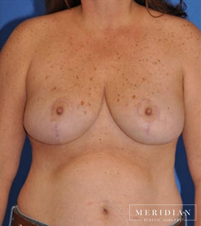 Breast Reduction: Patient 5 - After  