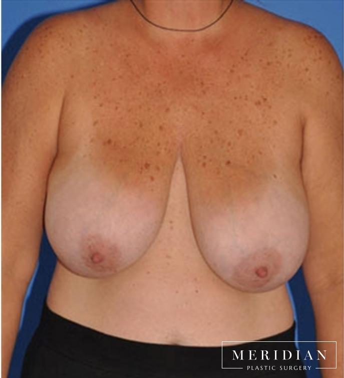 Breast Reduction: Patient 5 - After  