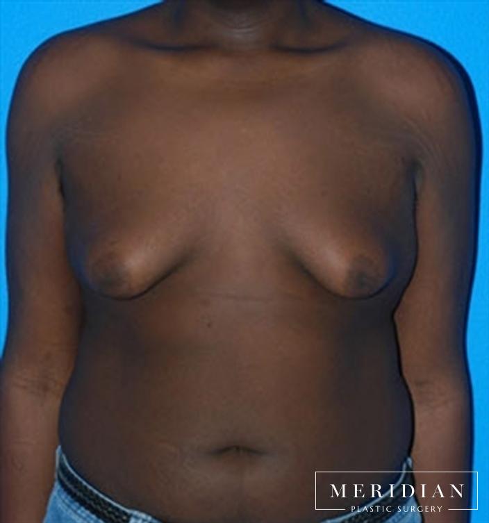 Gynecomastia: Patient 2 - After  