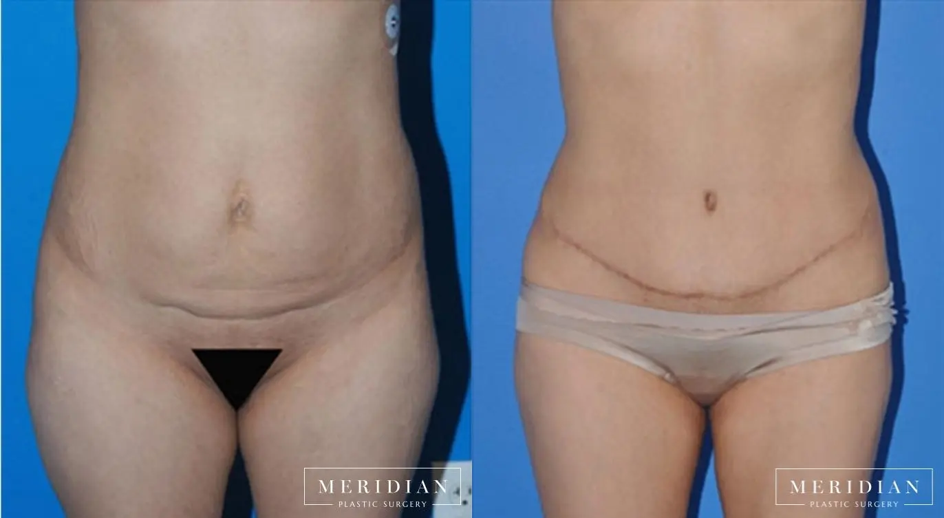 Abdominoplasty: Patient 10 - Before and After  