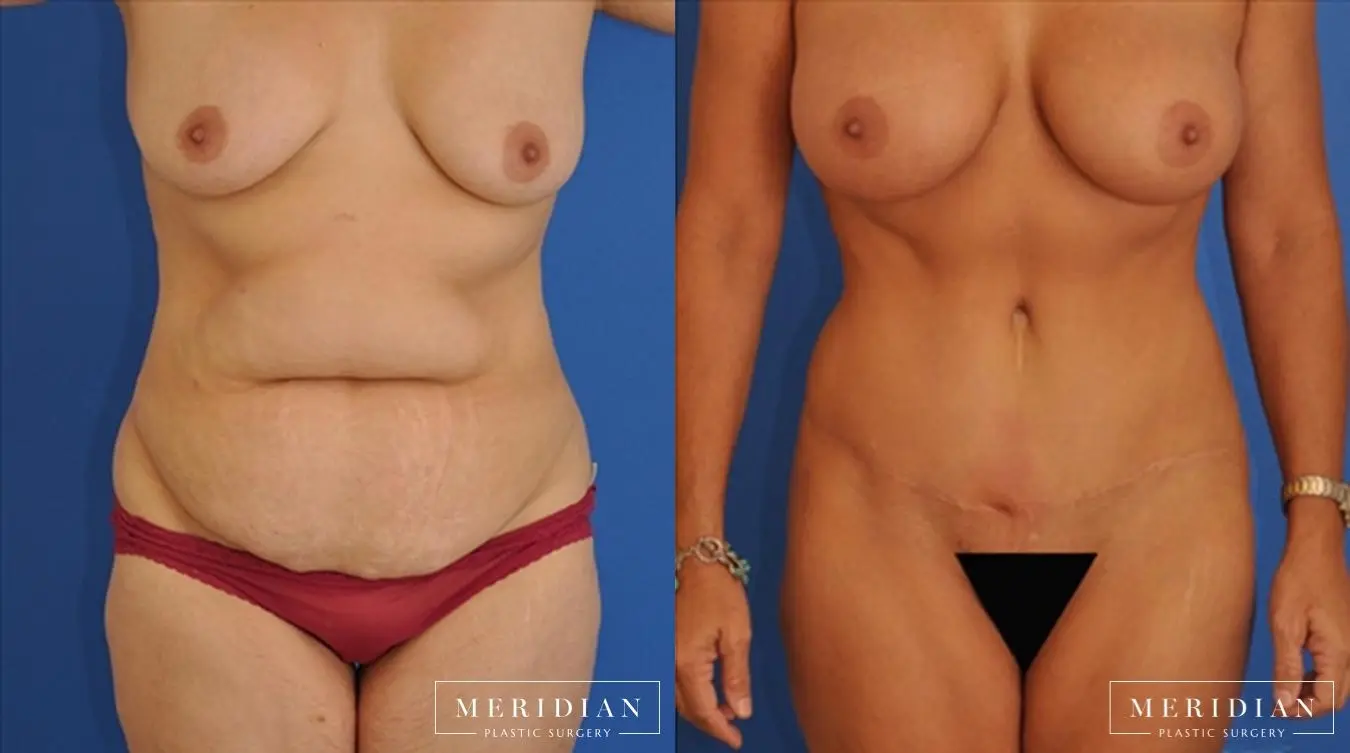 Abdominoplasty: Patient 1 - Before and After  