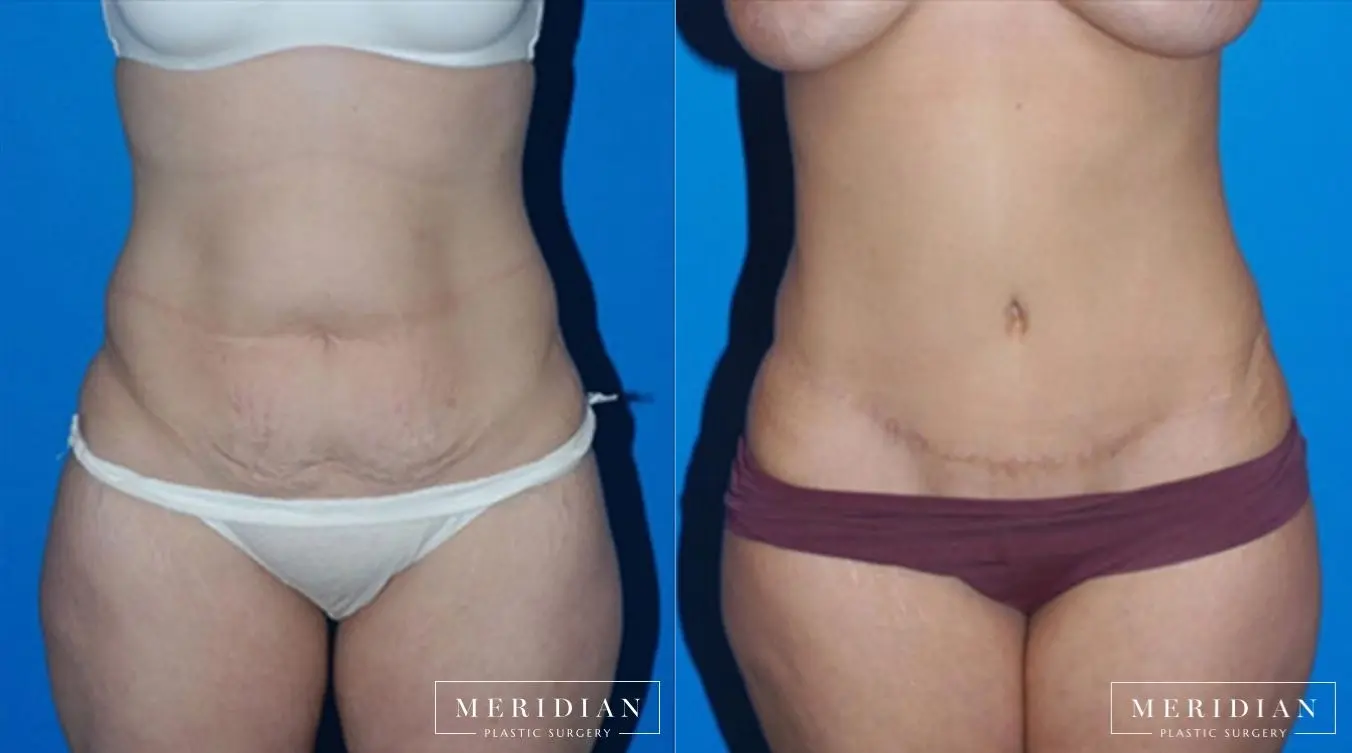 Abdominoplasty: Patient 4 - Before and After  