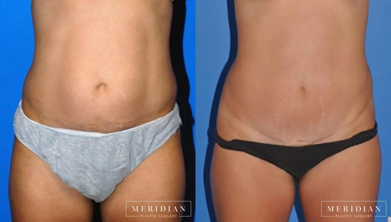 Abdominoplasty: Patient 6 - Before and After  