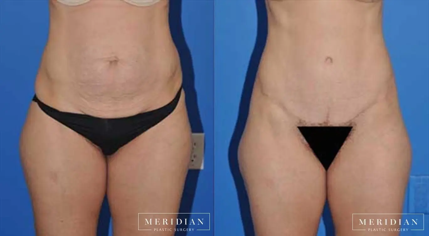 Abdominoplasty: Patient 3 - Before and After  