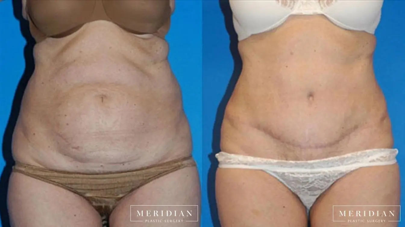 Abdominoplasty: Patient 8 - Before and After  