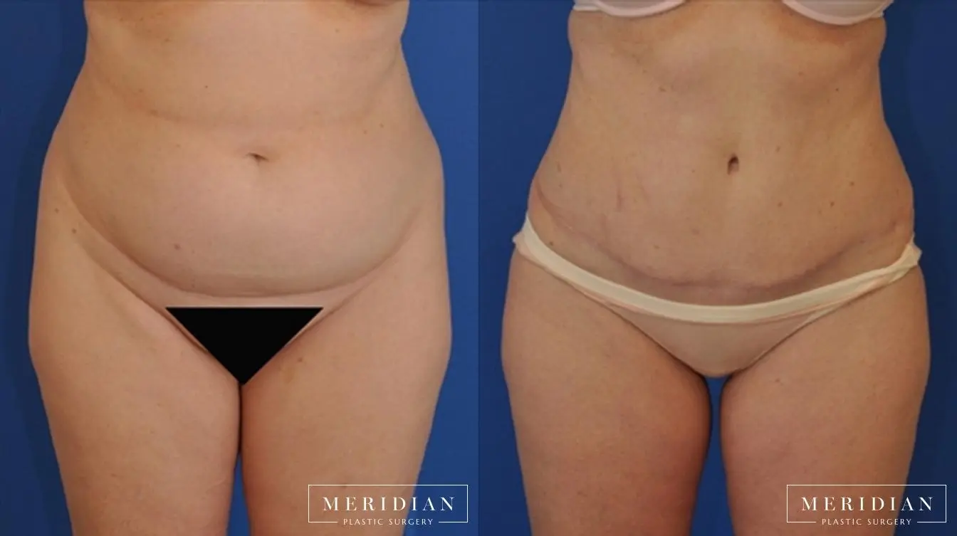 Abdominoplasty: Patient 7 - Before and After  