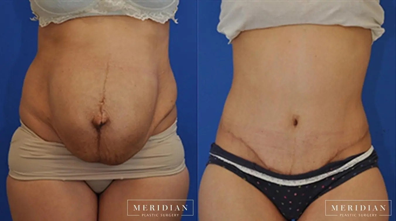 Abdominoplasty: Patient 5 - Before and After  