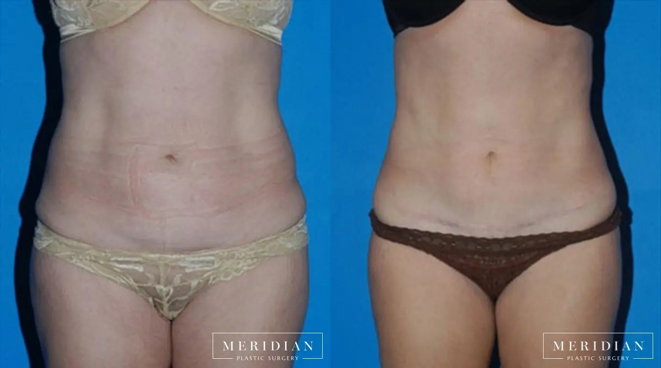 Abdominoplasty: Patient 9 - Before and After  