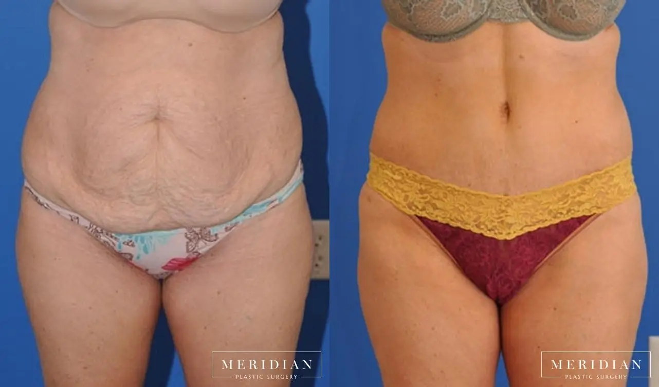 Abdominoplasty: Patient 2 - Before and After  