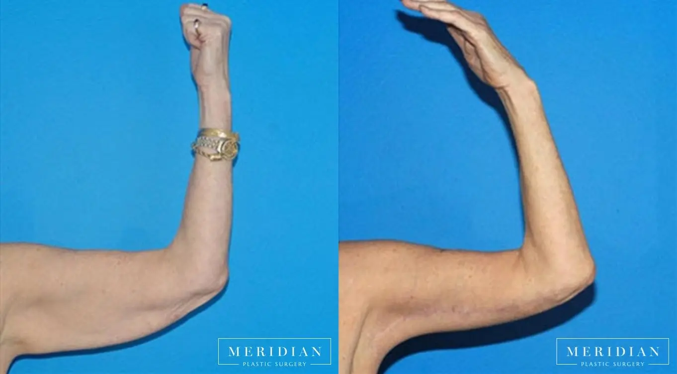 Arm Lift: Patient 1 - Before and After  