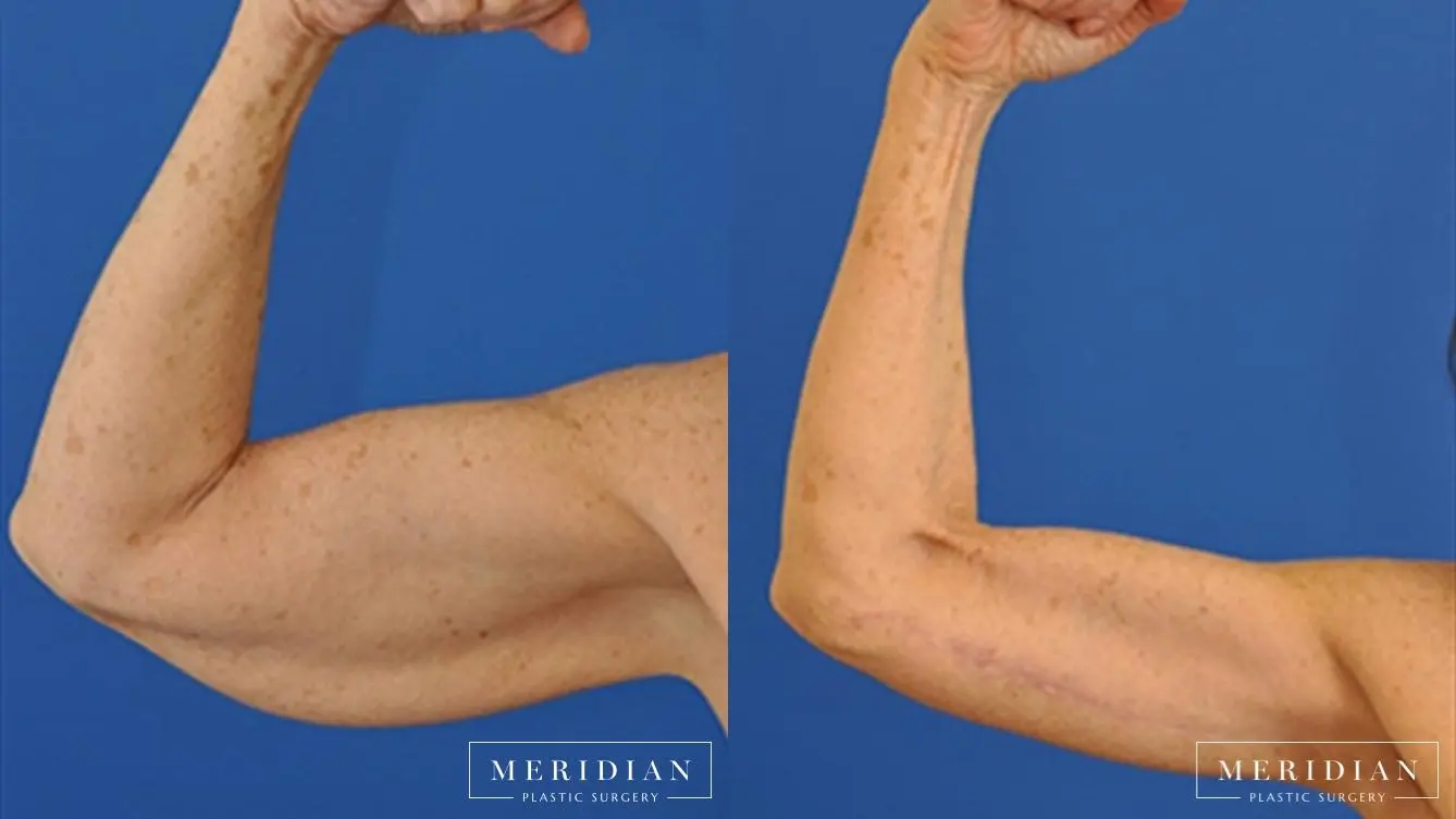 Arm Lift: Patient 2 - Before and After  