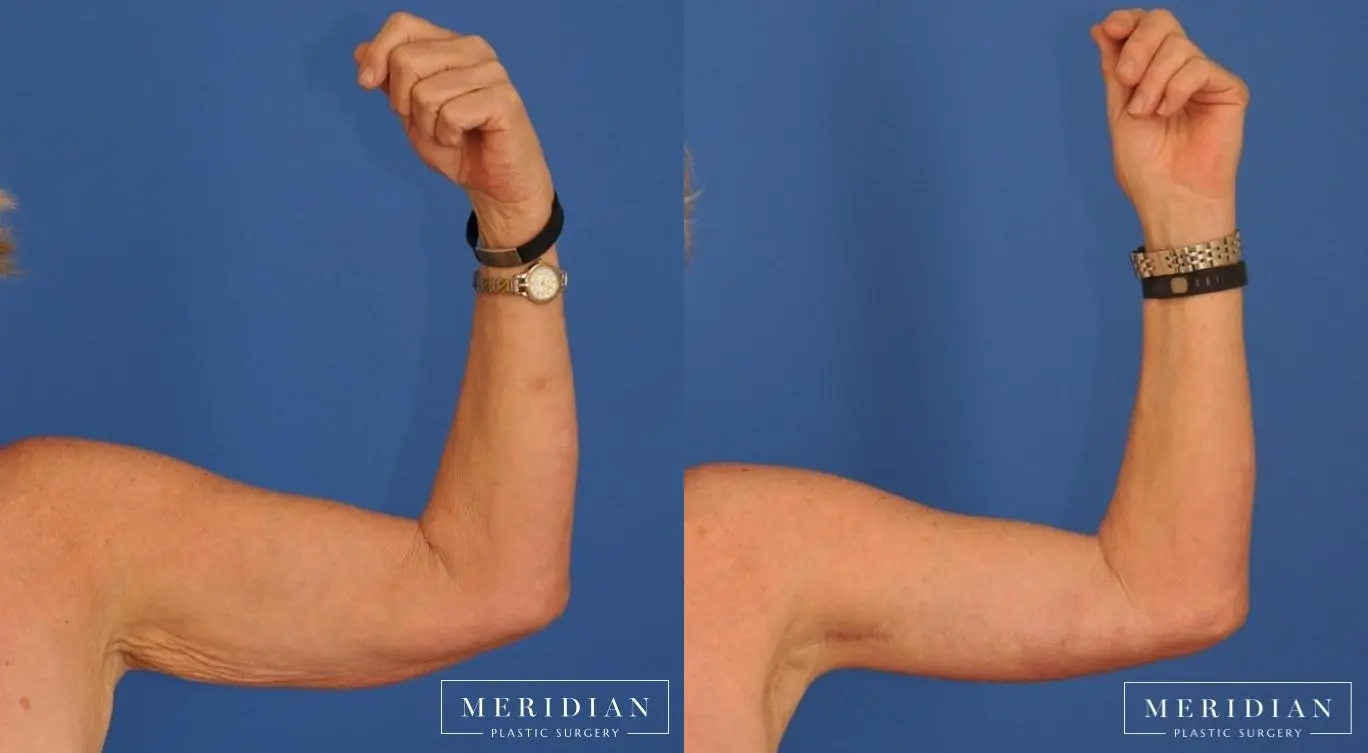 Arm Lift: Patient 4 - Before and After  