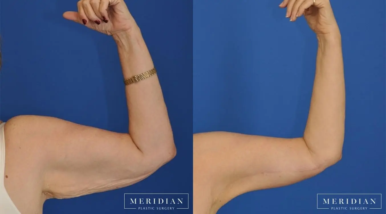 Arm Lift: Patient 3 - Before and After  