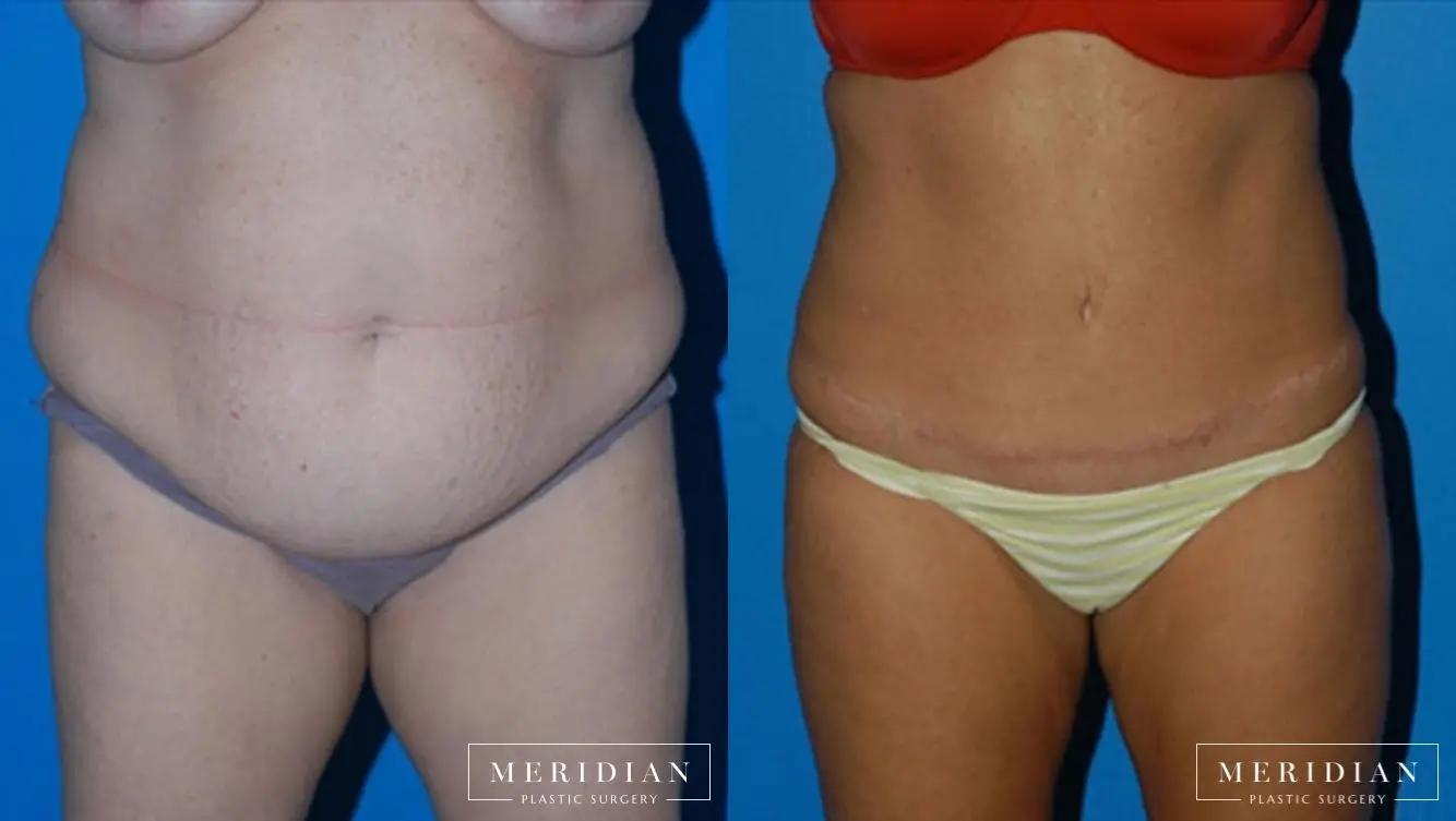 Body Contouring: Patient 3 - Before and After  