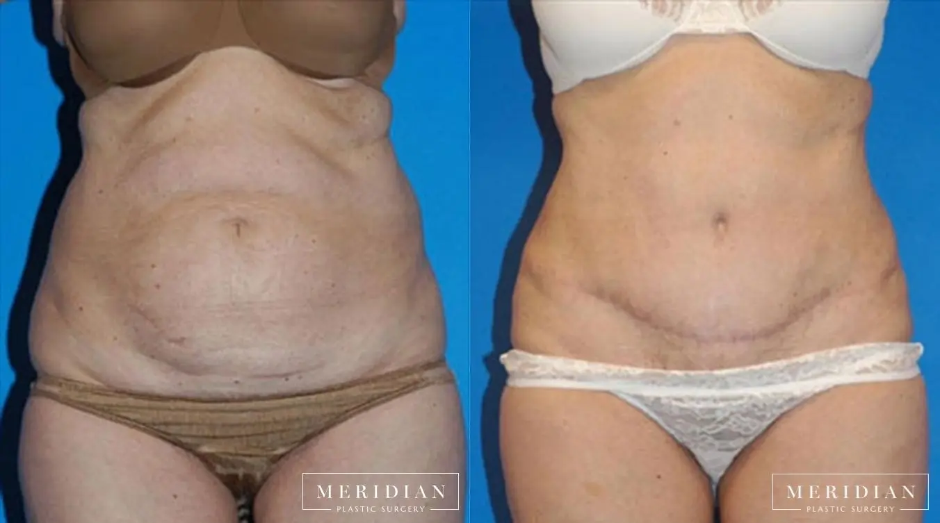 Body Contouring: Patient 4 - Before and After  