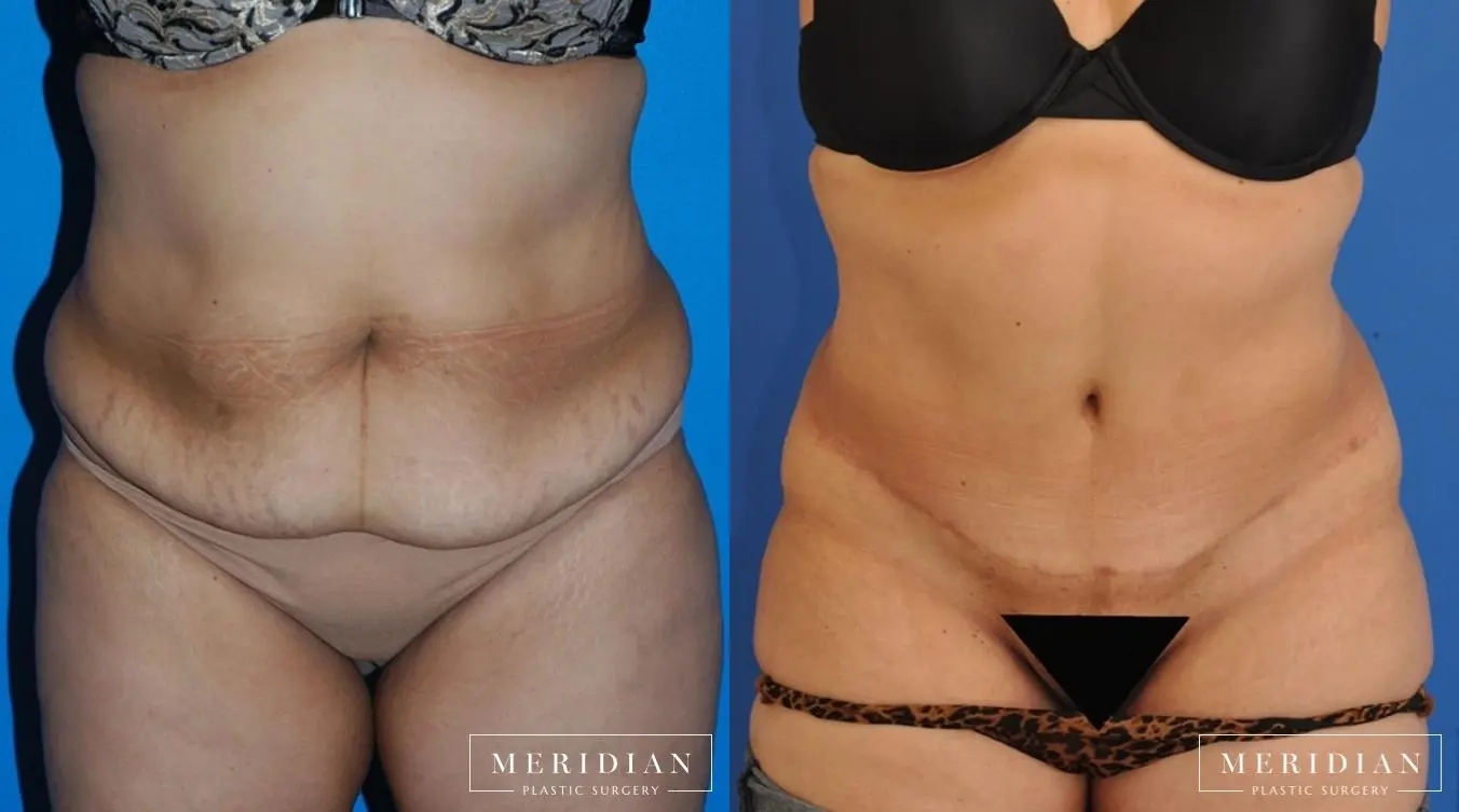 Body Contouring: Patient 8 - Before and After  