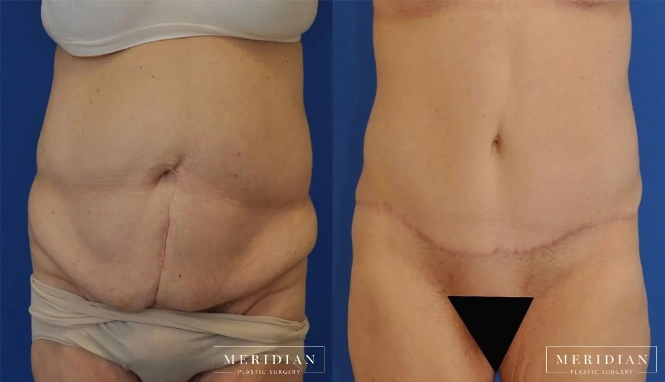 Body Contouring: Patient 9 - Before and After  