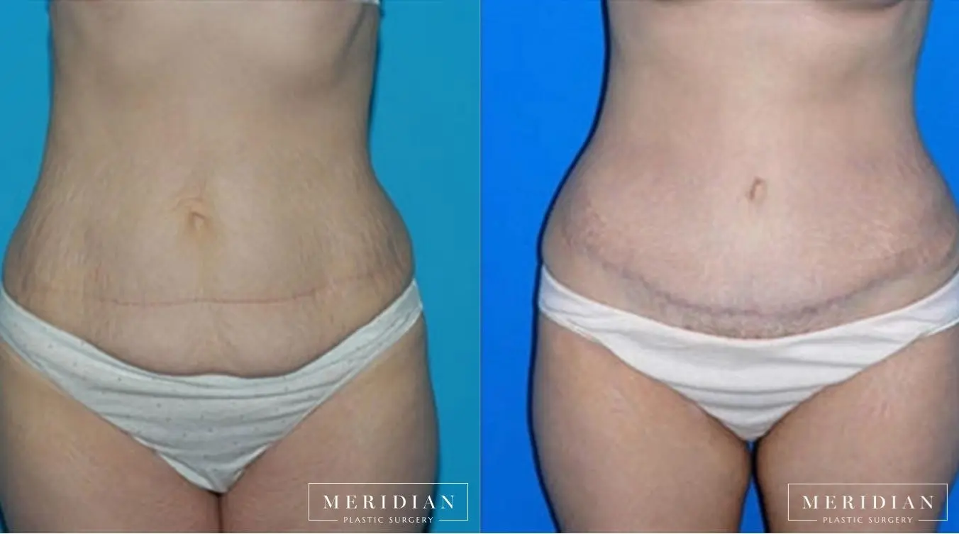 Body Contouring: Patient 6 - Before and After  