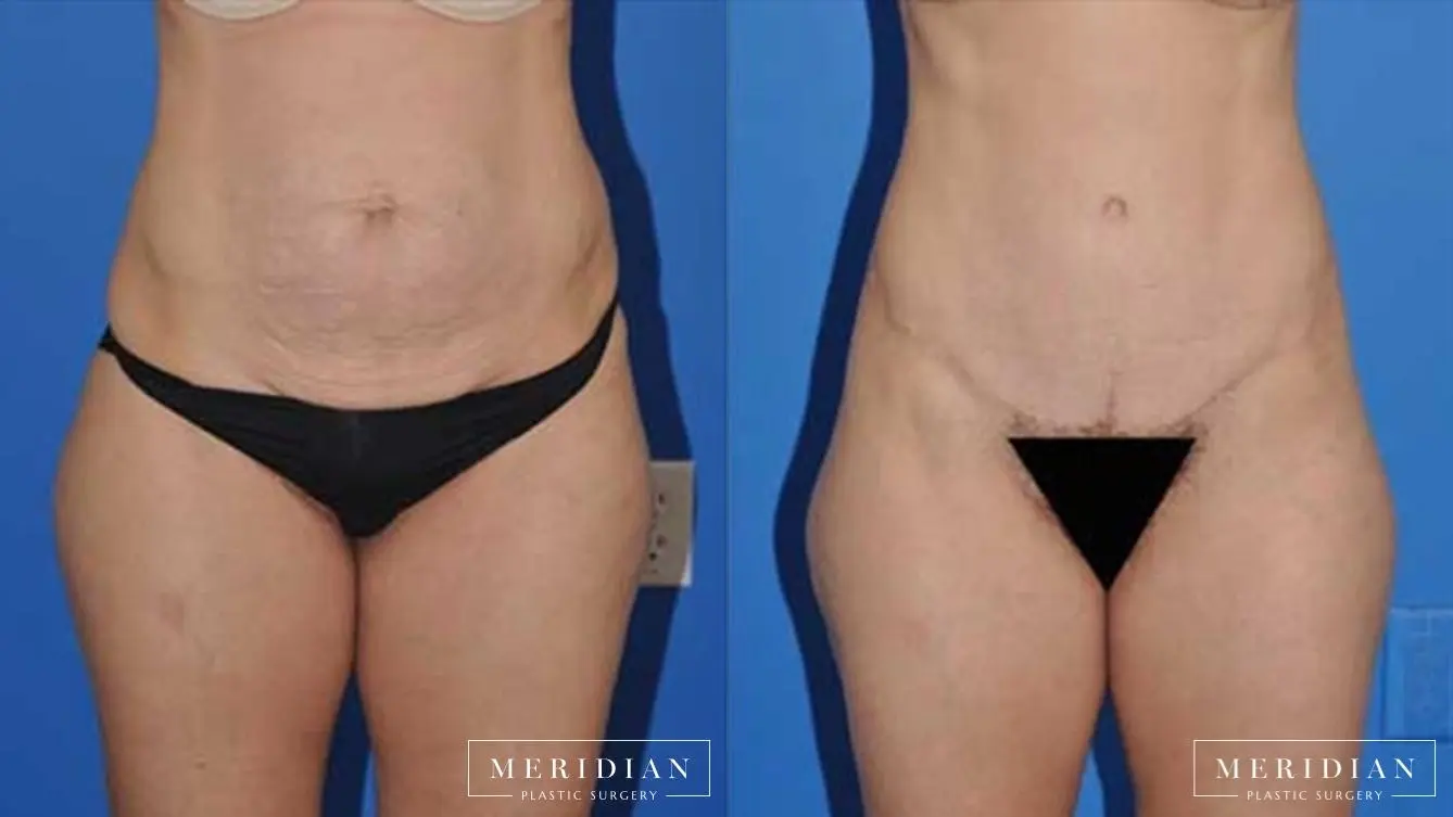 Body Contouring: Patient 2 - Before and After  