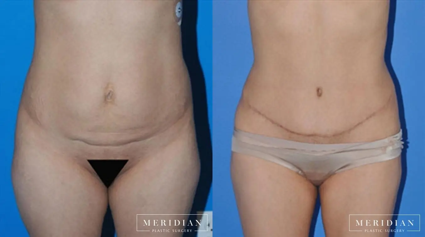 Body Contouring: Patient 5 - Before and After  