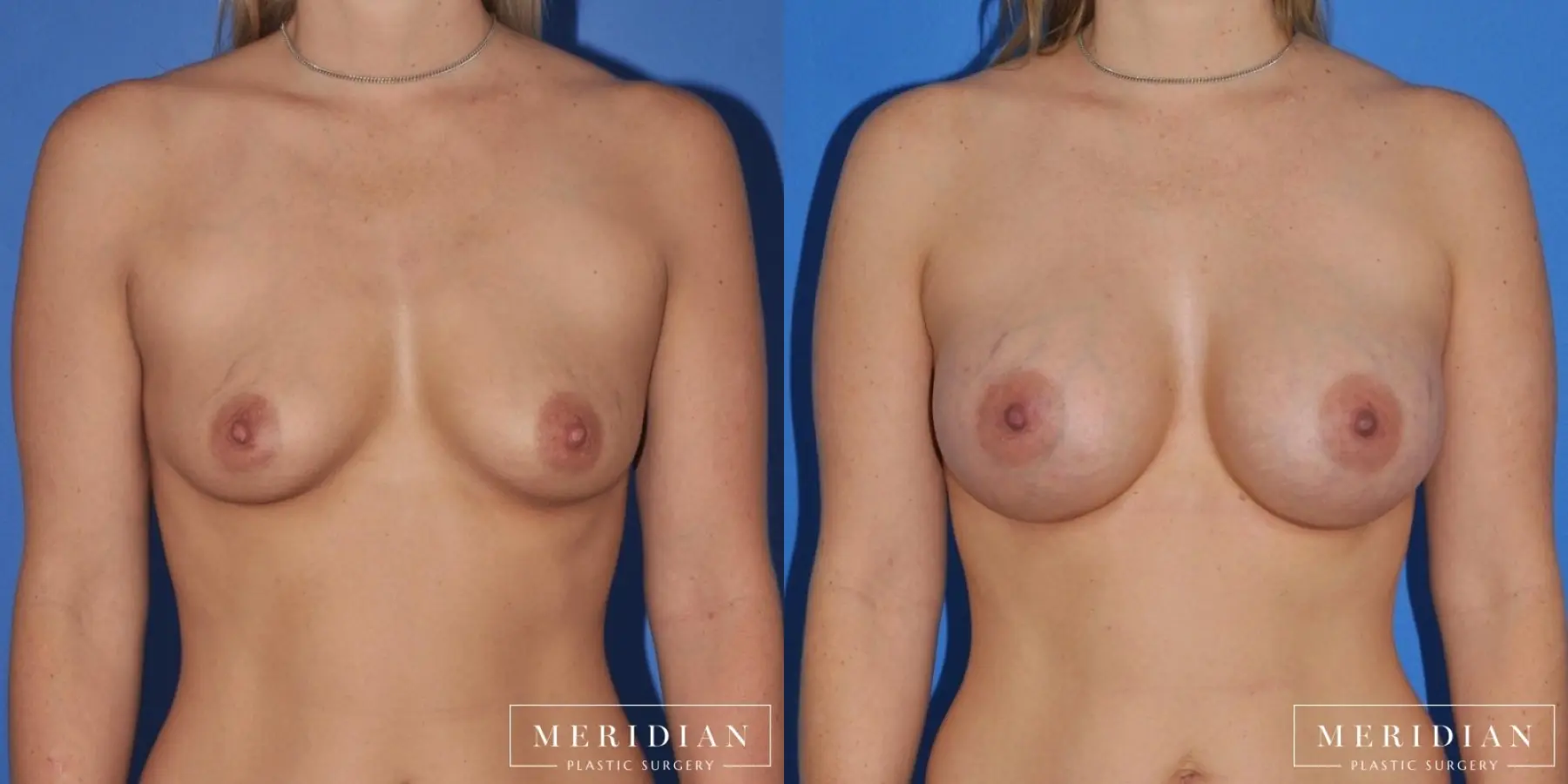 Breast Augmentation: Patient 2 - Before and After  