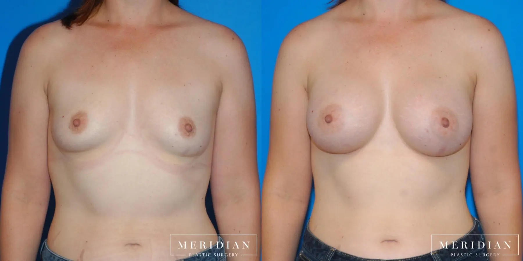 Breast Augmentation: Patient 4 - Before and After  