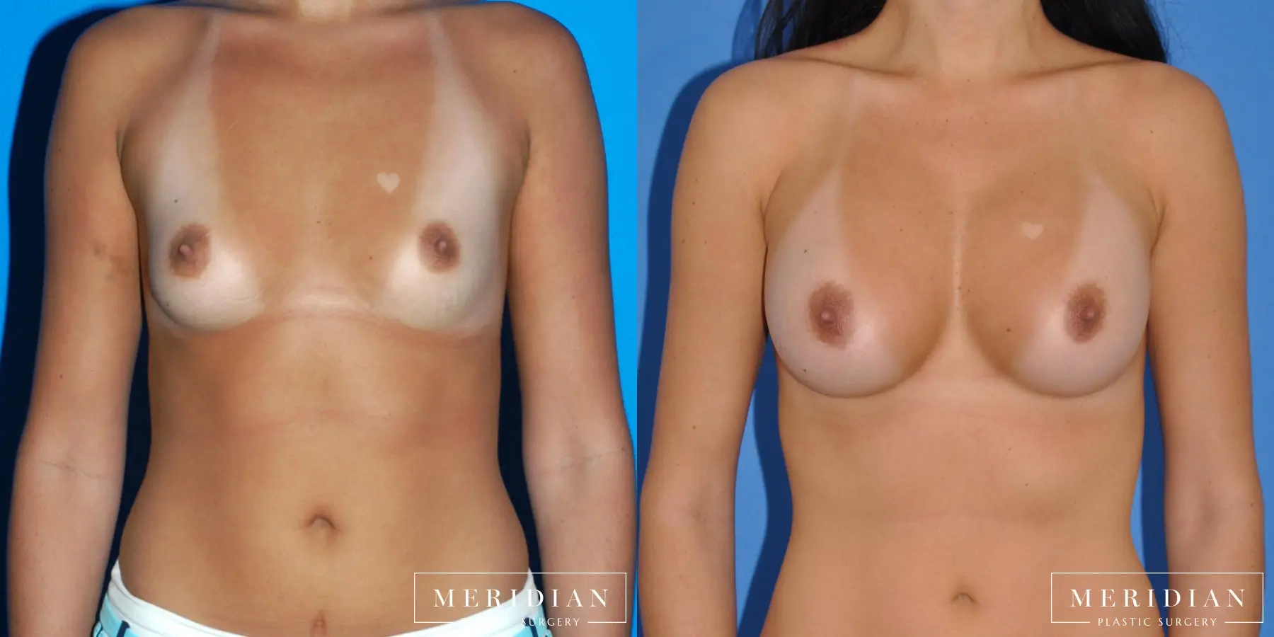 Breast Augmentation: Patient 9 - Before and After  