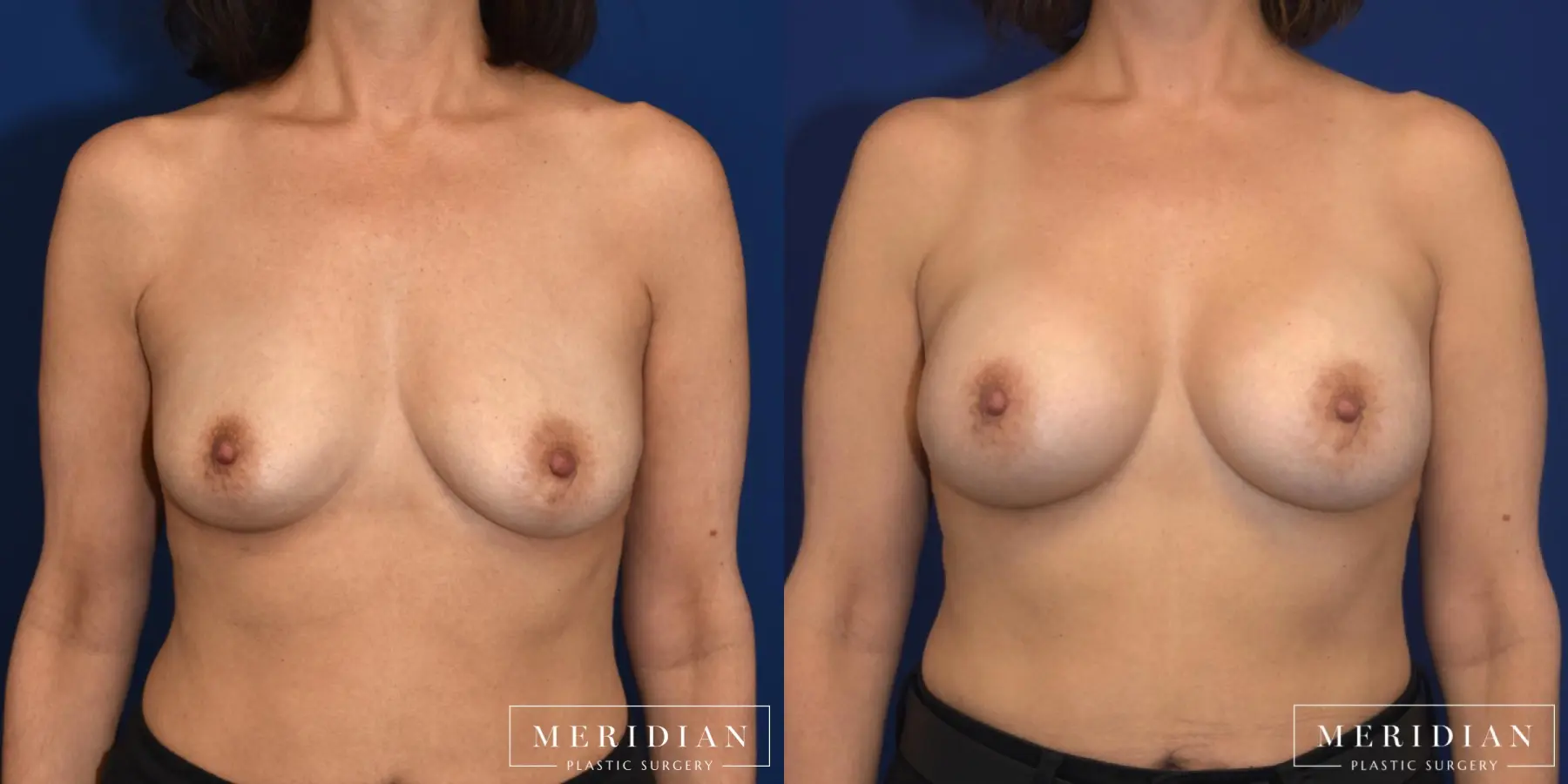 Breast Augmentation: Patient 8 - Before and After  