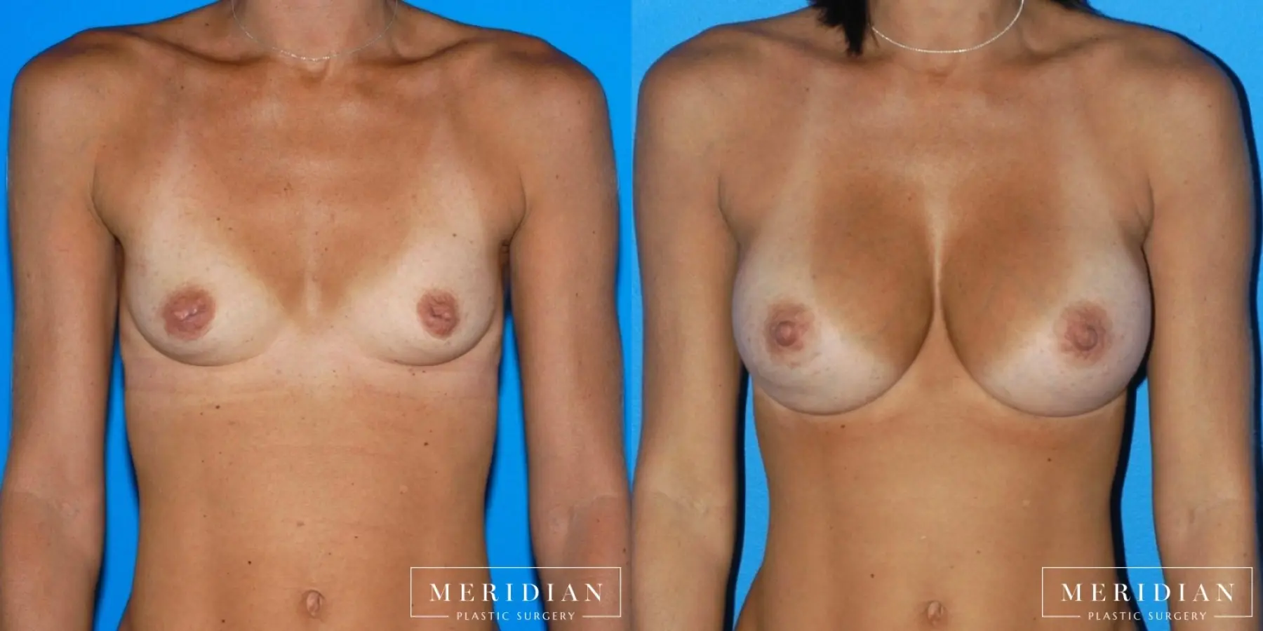 Breast Augmentation: Patient 1 - Before and After  