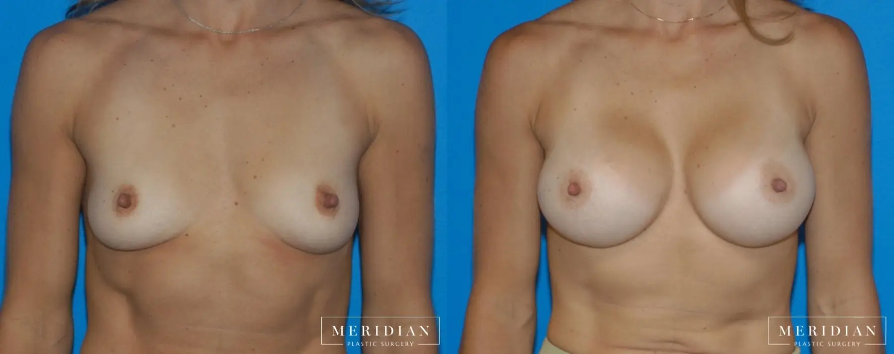 Breast Augmentation: Patient 17 - Before and After  