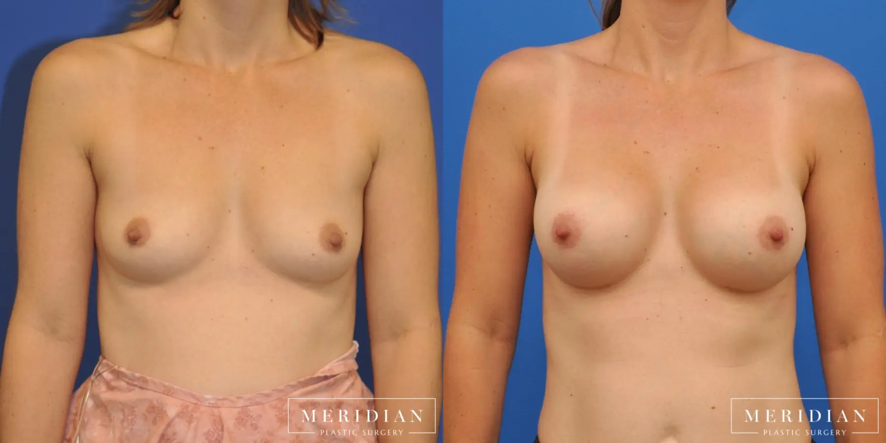 Breast Augmentation: Patient 3 - Before and After  