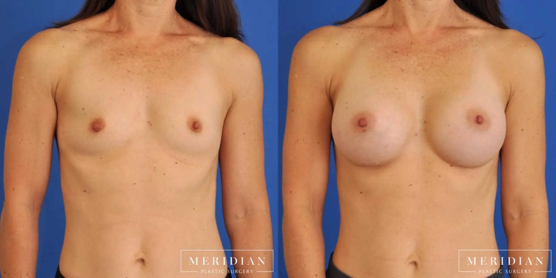 Breast Augmentation: Patient 6 - Before and After  