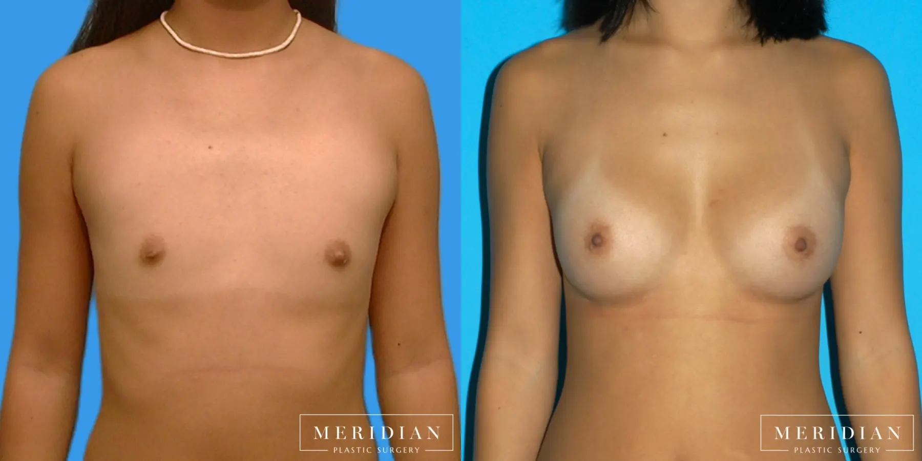 Breast Augmentation: Patient 7 - Before and After  