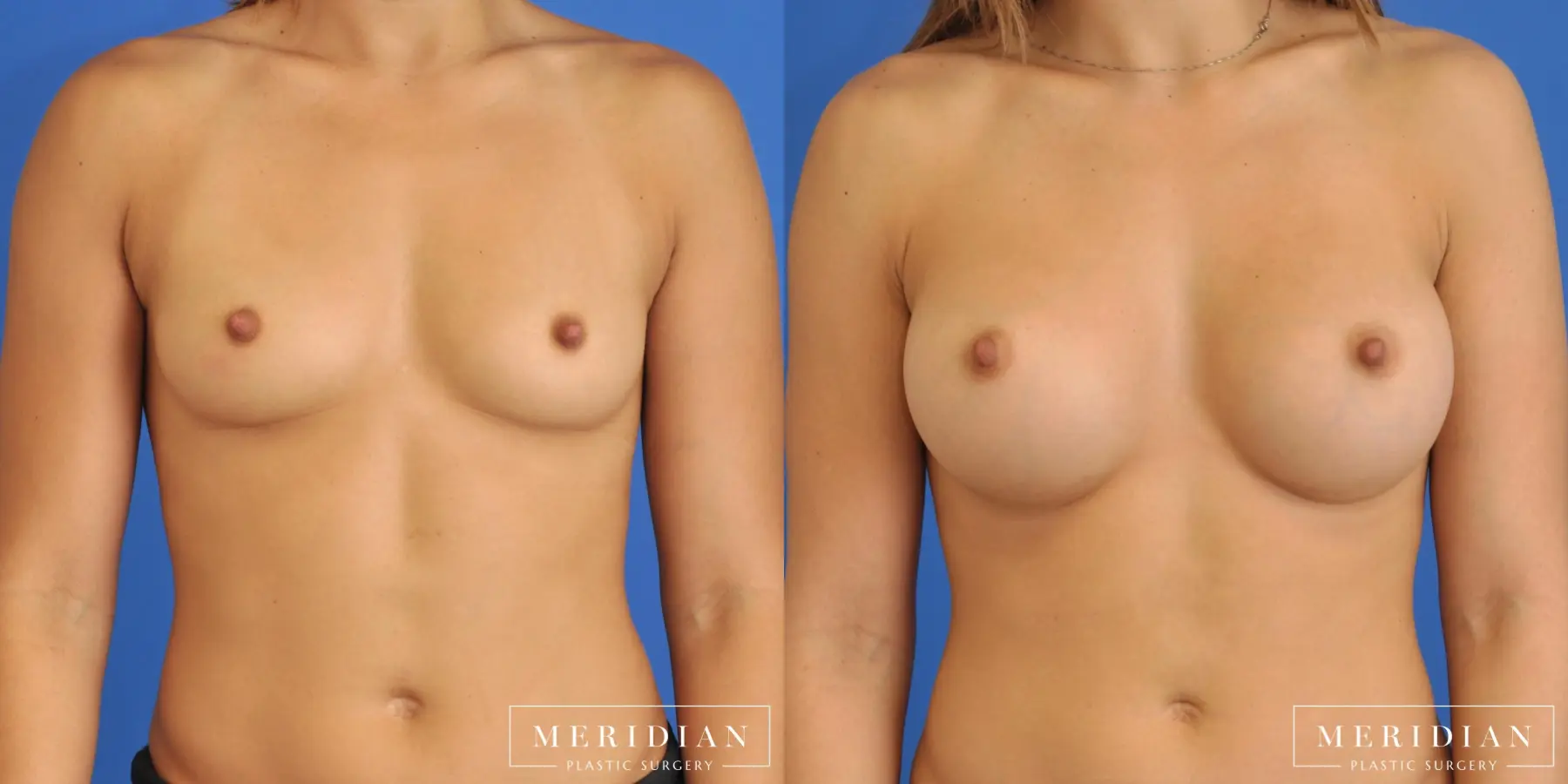 Breast Augmentation: Patient 5 - Before and After  